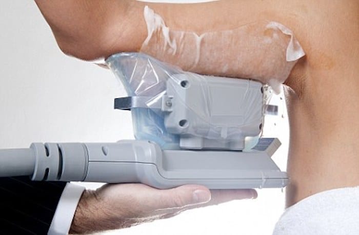 fat freezing arms Lancaster