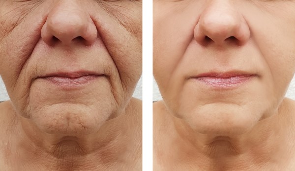 Learn more about Morpheus8 Treatment Lancaster today!