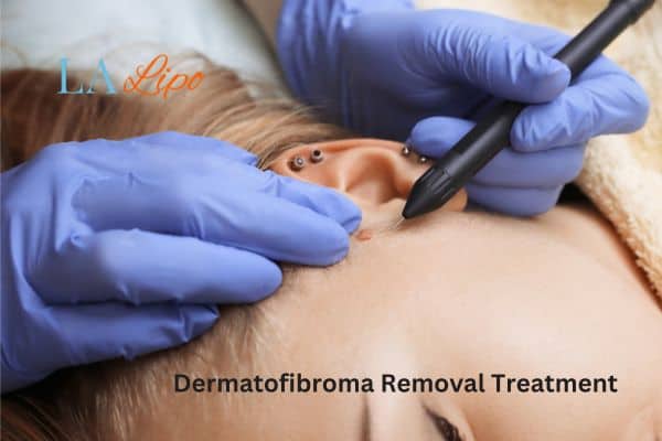 Dermatofibroma Removal Treatment Lancaster