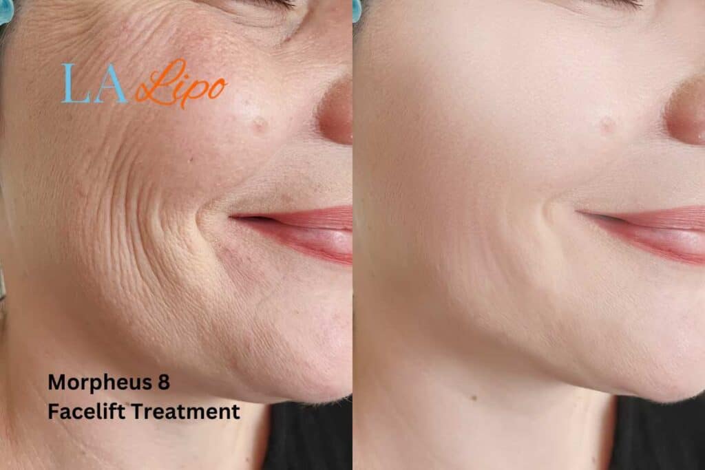 Morpheus8 Treatment Lancaster for flawless skin! Call us today!