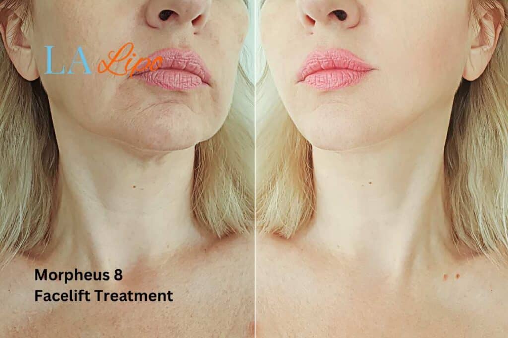 Turn back time with Morpheus8 Treatment Lancaster