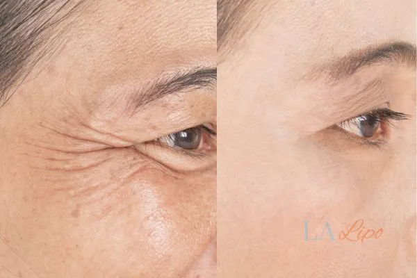 Before and after results of woman - HI-fu wrinkles reduction treatment Lancaster