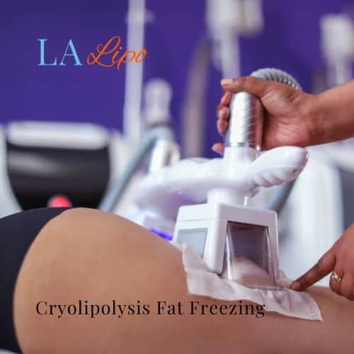 fat freezing - Cryolipolysis Lancaster
