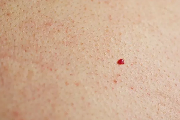 close up of a cherry angioma Lancaster