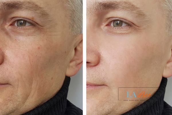 See the amazing results of Morpheus8 Treatment Lancaster!