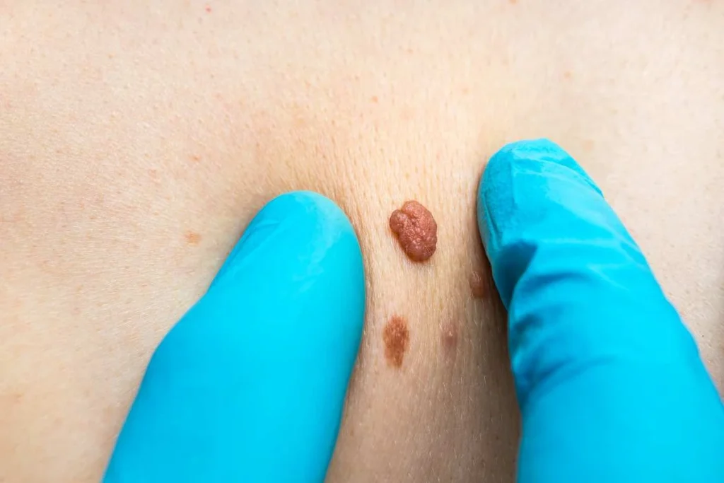 LA LIPO Cryopen Lesion Removal Prices Lancaster