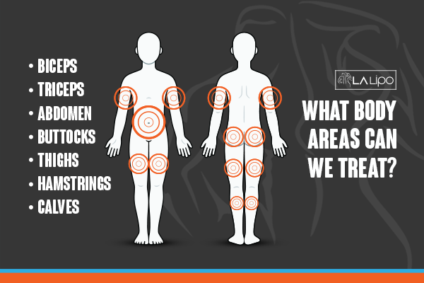 Diagram to show areas you can have LA-EMS Body Sculpting Treatment Lancaster