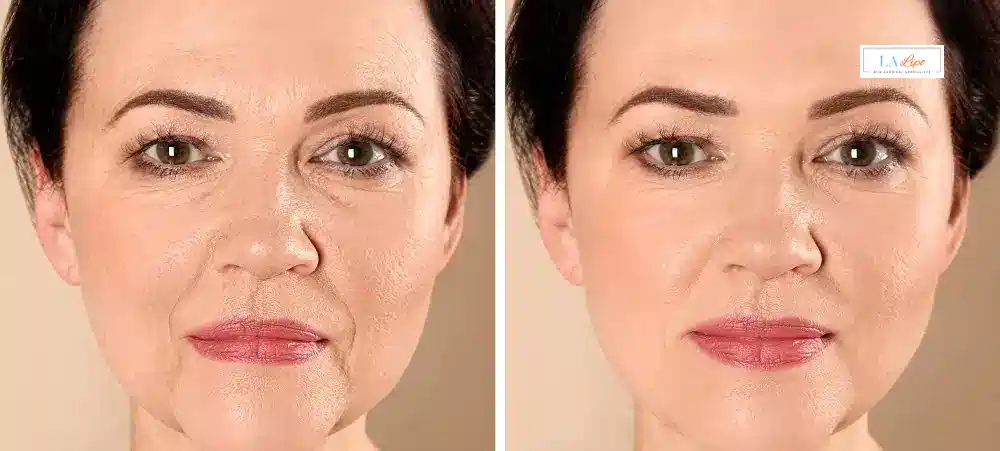 How Long Does It Take to See Results and How Long Do They Last Lancaster?